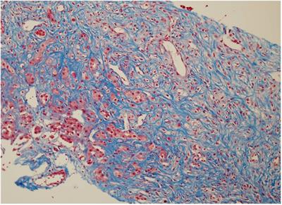 Liver fibrosis among infants with t(1;22)(p13;q13) acute megakaryoblastic leukemia: a case report and literature review